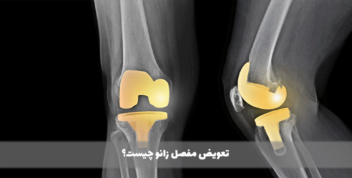 تعویض مفصل زانو چیست؟