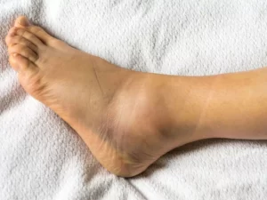 پیچ خوردگی مچ پا