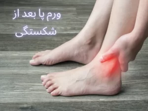 درمان ورم پا بعد از شکستگی