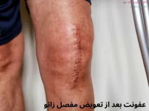 عفونت بعد از تعویض مفصل زانو