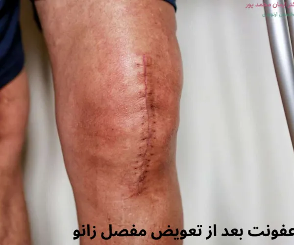 علت عفونت بعد از تعویض مفصل زانو