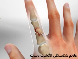 علائم شکستگی انگشت دست