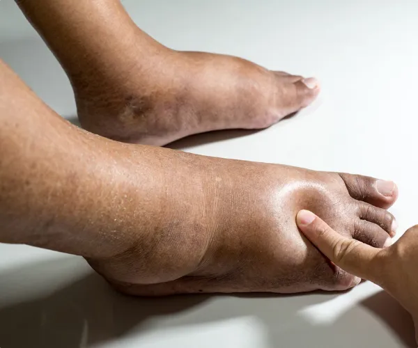 عکس ورم پا بعد از باز كردن گچ