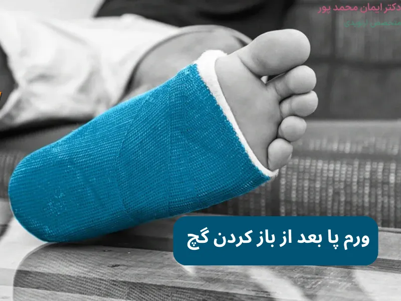 ورم پا بعد از باز كردن گچ