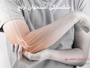 شکستگی استخوان آرنج