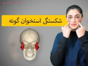 شکستگی استخوان گونه چیست