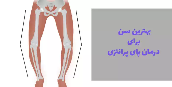 بهترین سن برای درمان پای پرانتزی