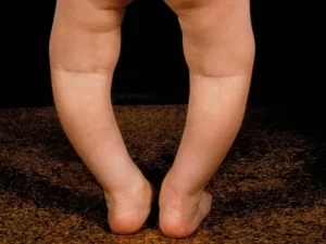 سن برای درمان پای پرانتزی