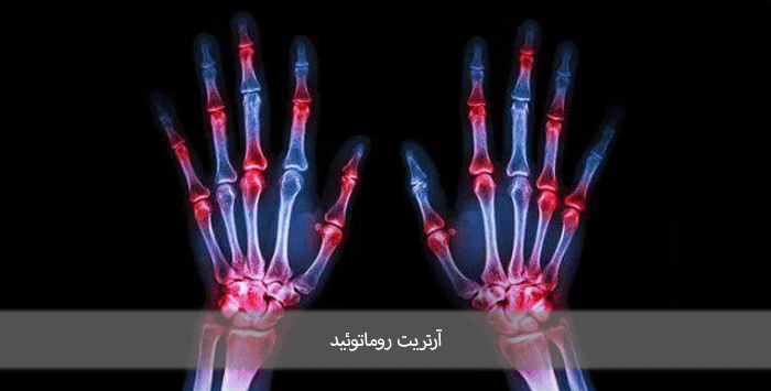 آرتریت روماتوئید