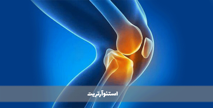 استئوآرتریت