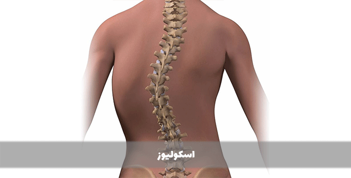 اسکولیوز