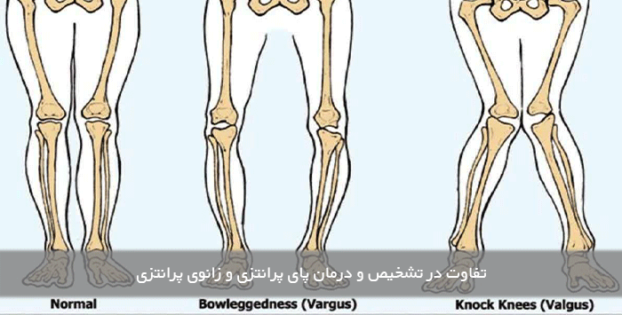 تفاوت در تشخیص و درمان پای پرانتزی و زانوی پرانتزی