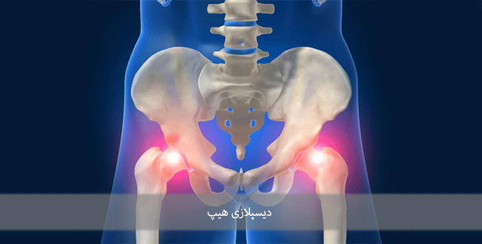 دیسپلازی هیپ