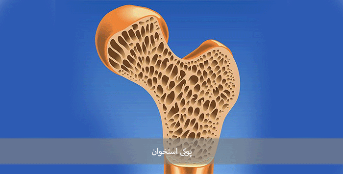 پوکی استخوان