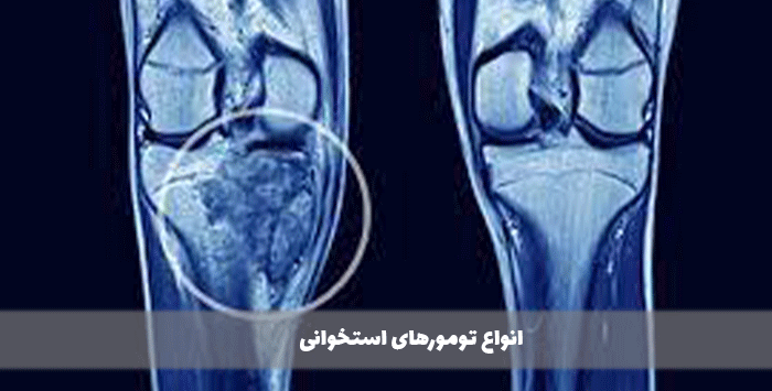 انواع تومورهای استخوانی