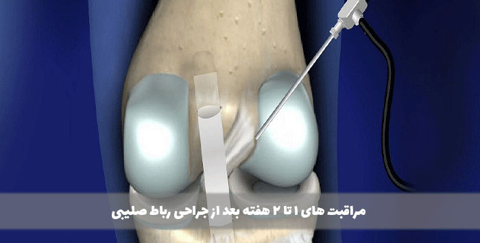 مراقبت های 1 تا 2 هفته بعد از جراحی رباط صلیبی