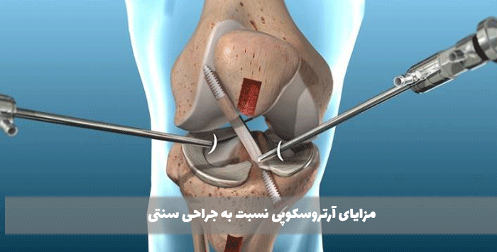 مزایای آرتروسکوپی نسبت به جراحی سنتی