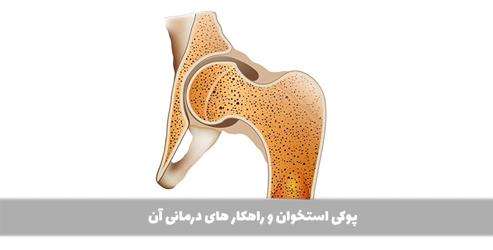 پوکی استخوان و راهکار های درمانی آن