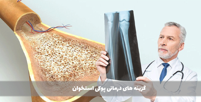 گزینه های درمانی پوکی استخوان