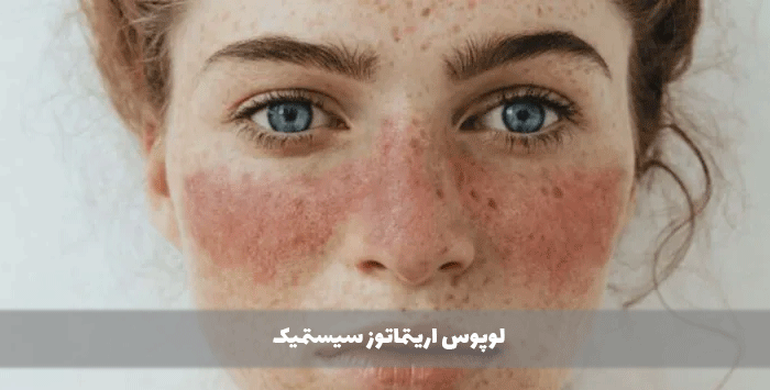 لوپوس اریتماتوز سیستمیک