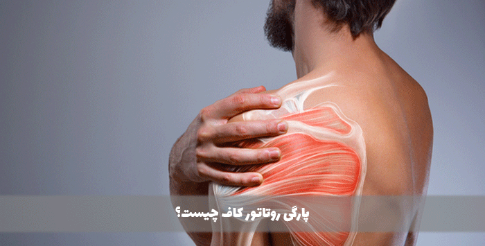 پارگی روتاتور کاف چیست؟