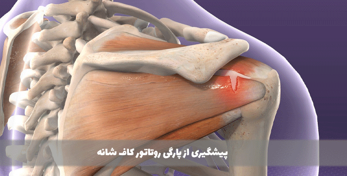 پیشگیری از پارگی روتاتور کاف شانه