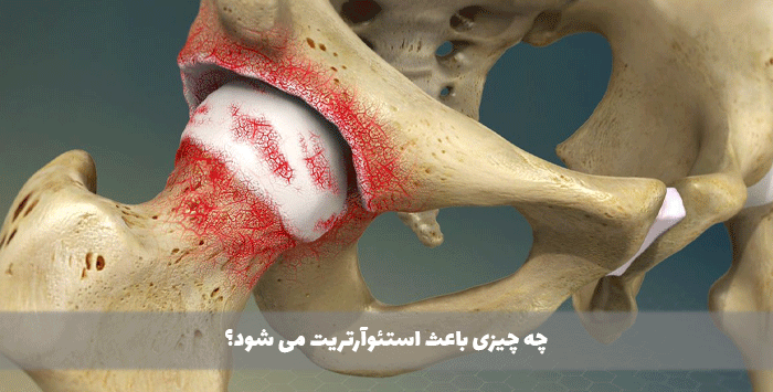 چه چیزی باعث استئوآرتریت می شود؟