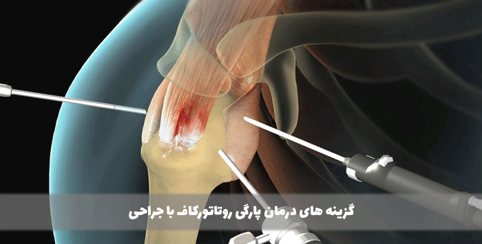 گزینه های درمان پارگی روتاتورکاف با جراحی