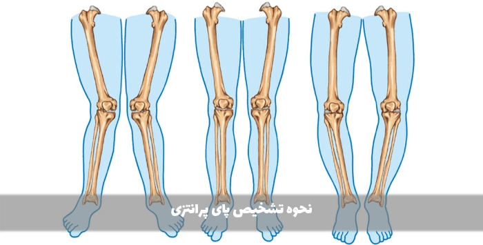 نحوه تشخیص پای پرانتزی