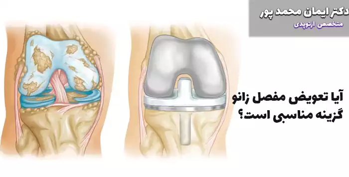 آیا تعویض مفصل زانو گزینه مناسبی است؟