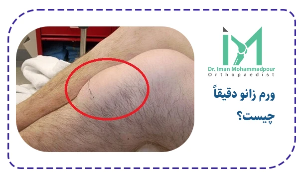 ورم زانو دقیقاً چیست؟