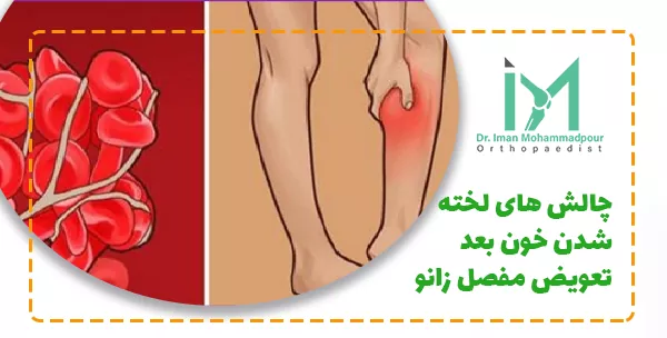 چالش های لخته شدن خون بعد تعویض مفصل زانو