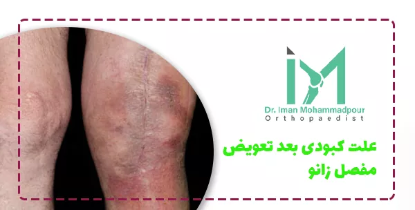 علت کبودی بعد تعویض مفصل زانو