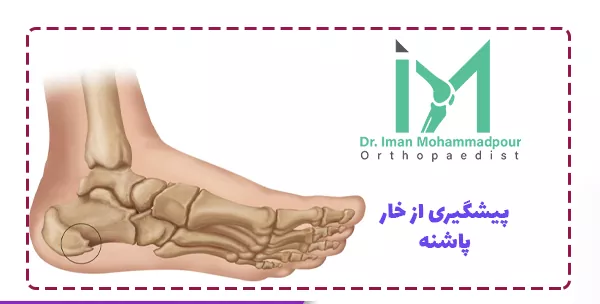 پیشگیری از خار پاشنه