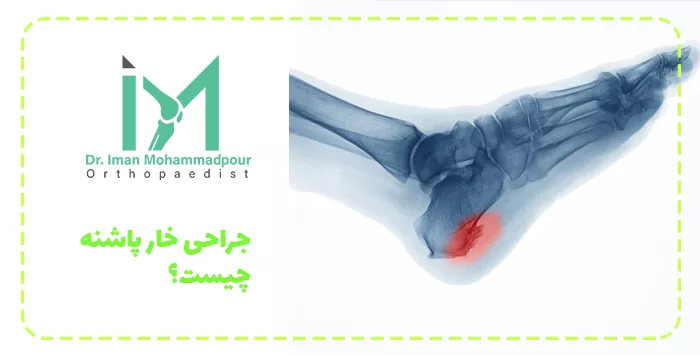 جراحی خار پاشنه چیست؟