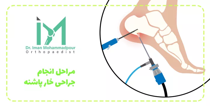 مراحل انجام جراحی خار پاشنه