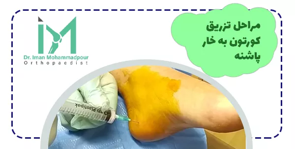 مراحل تزریق کورتون به خار پاشنه