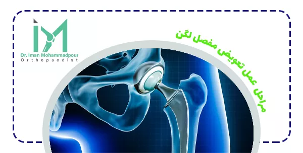 مراحل عمل تعویض مفصل لگن
