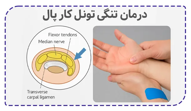 درمان تنگی تونل کارپال چگونه است؟