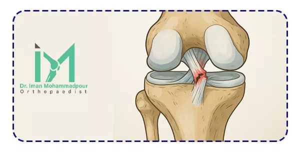 پارگی رباط صلیبی چیست