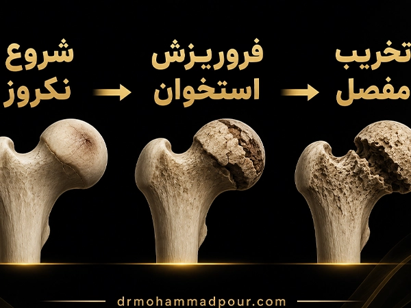 مراحل نکروز استخوان از شروع تا تخریب مفصل