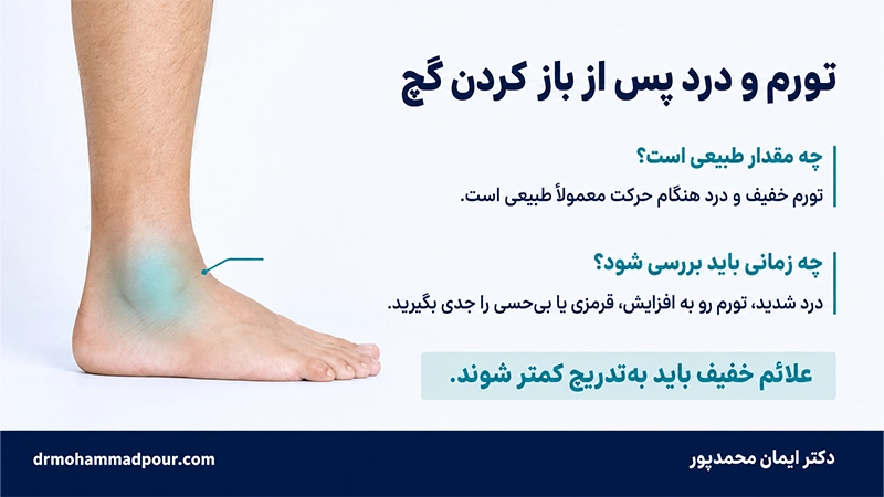 لنگیدن بعد از باز کردن گچ پا